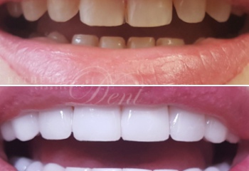 Различные виды виниров для зубов и особенности их установки