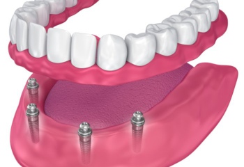 Протезирование на имплантах – метод реставрации зубного ряда
