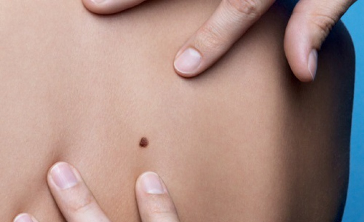 22 мая 2017 года – день диагностики меланомы в России